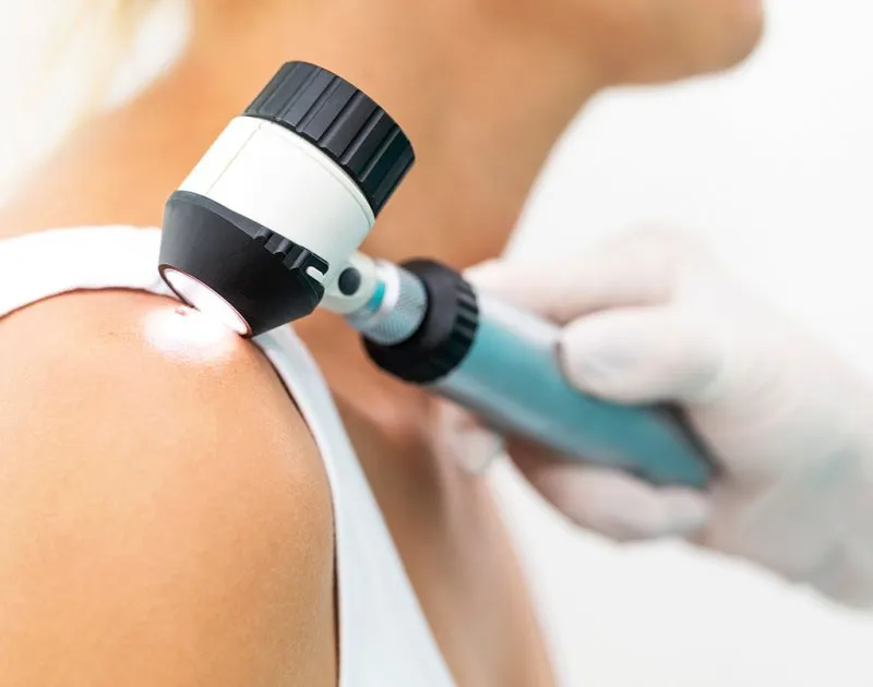 Tratamento do melanoma: o que esperar?